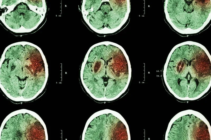 AVC du jeune adulte : les cas ont presque doublé en 27 ans