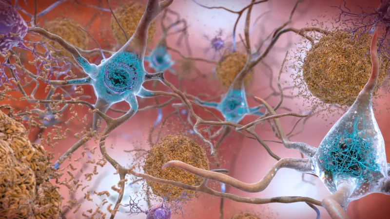 Alzheimer : retirer les plaques amyloïdes freine la protéine tau
