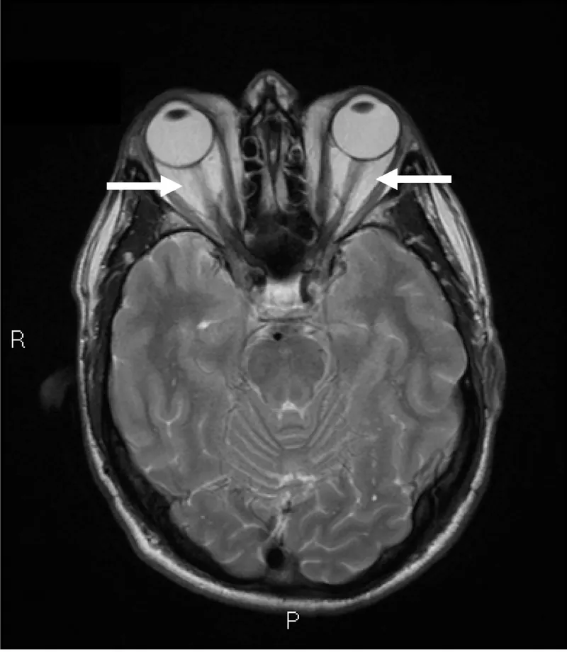 Maladie oculaire thyroïdienne : la FDA autorise Enspryng