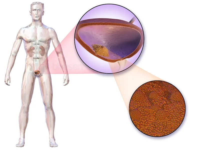 Anktiva : un traitement approuvé pour une forme de cancer de la vessie