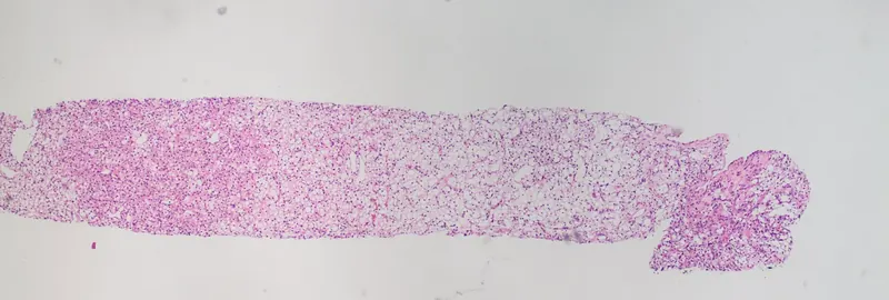 Belzutifan + lenvatinib : nouvelle option contre le cancer du rein