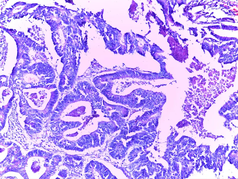 Cancer du rectum : la FDA approuve Jemperli (dostarlimab)