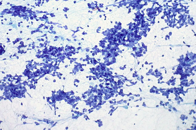 Cancer du poumon à petites cellules : des cellules T gamma delta