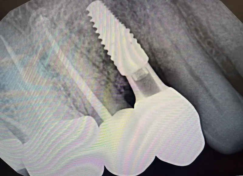 Implants dentaires : la piste TRPC1 contre l'inflammation osseuse