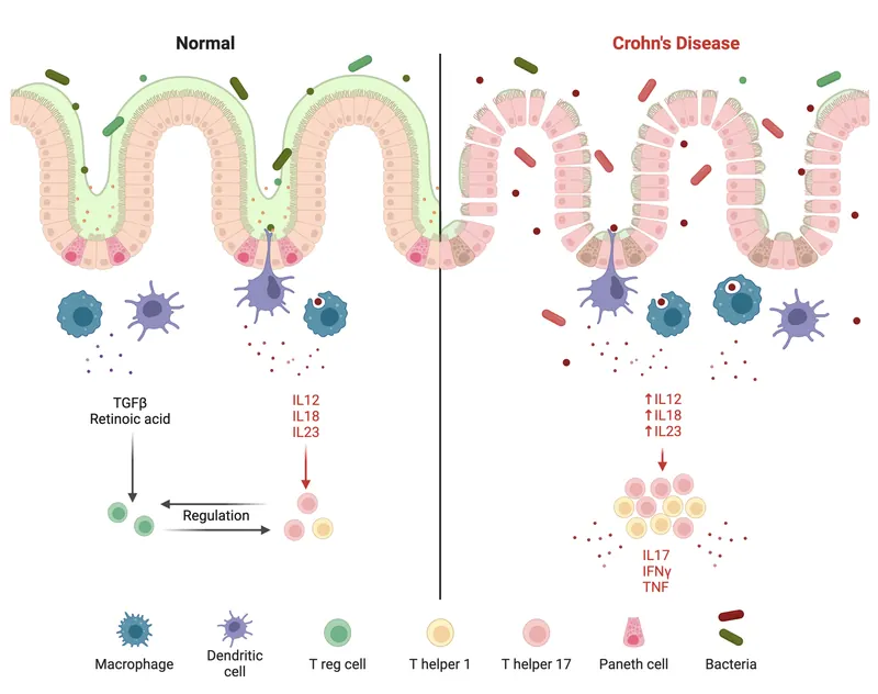 Maladie de Crohn : la FDA autorise Skyrizi en injection de départ
