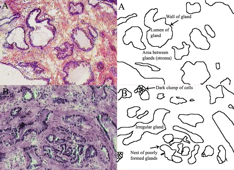 Talazoparib et enzalutamide : feu vert FDA, cancer de la prostate