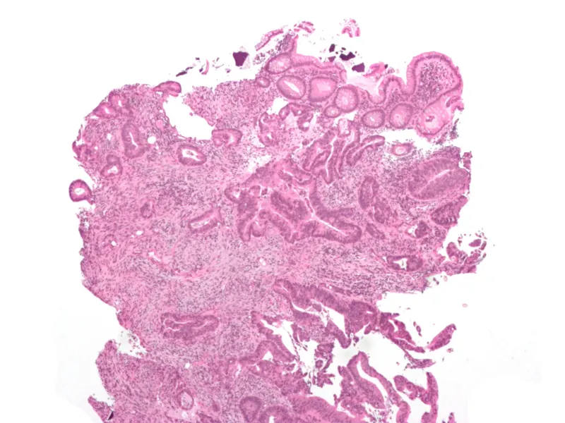Cancer du côlon de stade III : la FDA autorise Tecentriq en adjuvant