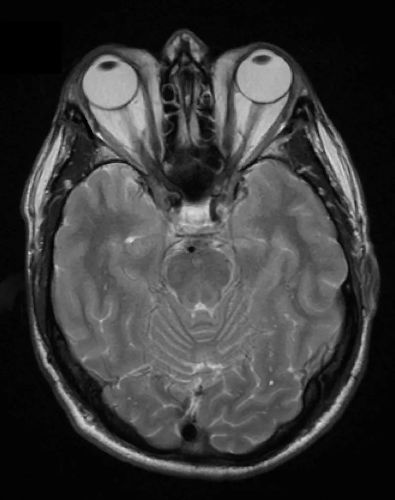 Maladie oculaire thyroïdienne : Sycume agit même à un stade chronique