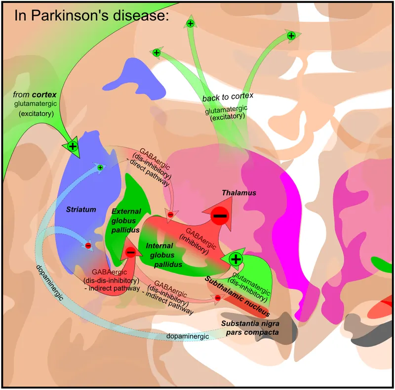 Solengepras : un nouveau traitement oral de Parkinson en phase 3