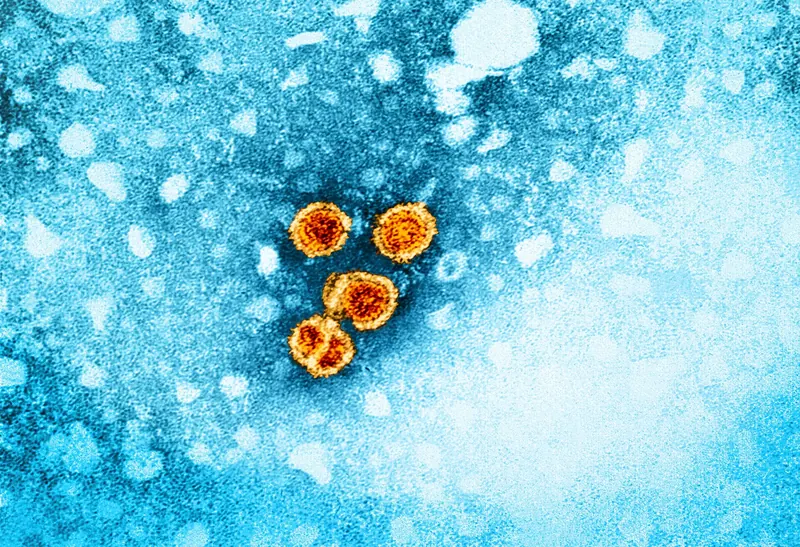 Bépirovirsen : hépatite B, une cure de 24 semaines vise la guérison